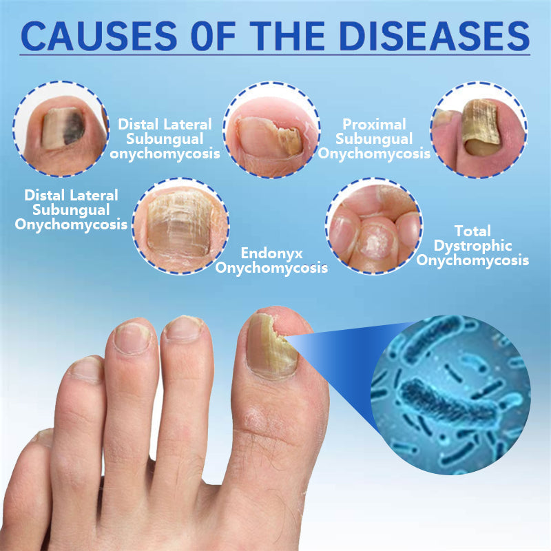 🔥(Official Mall)💖ODALIT™ Revolutionary High-Efficiency Light Therapy Device For Toenail Diseases-🗽Made and Shipped from USA 🔥