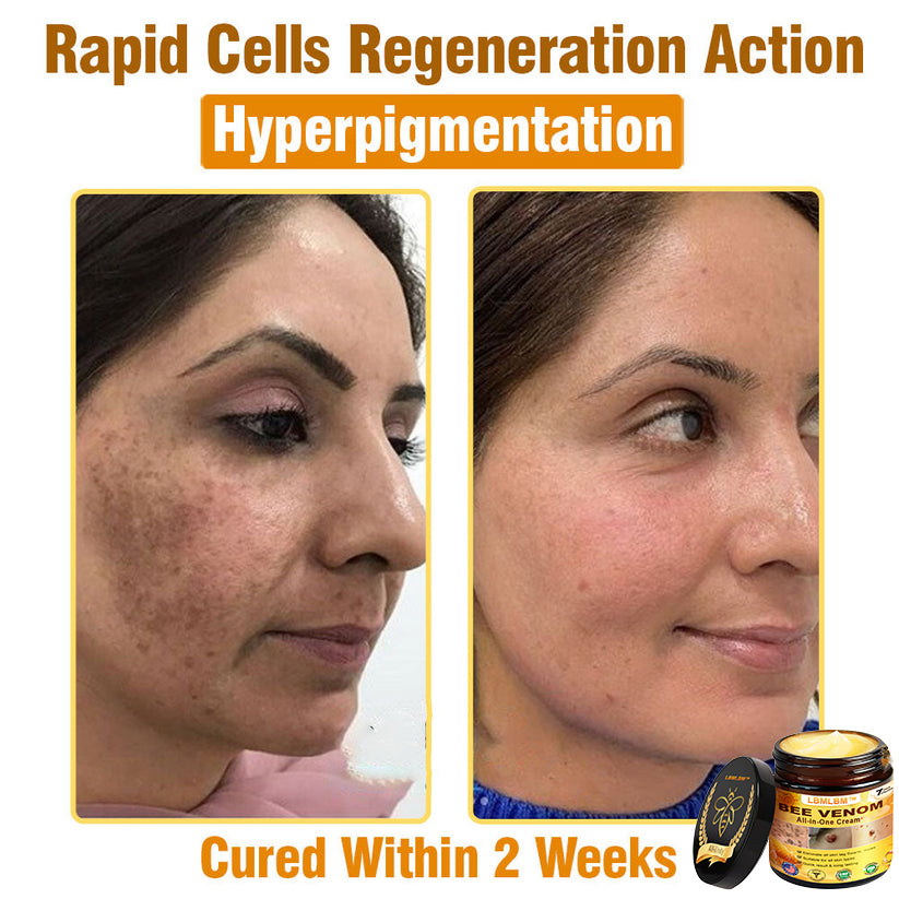LBMLBM™ Bee Venom All-in-One Cream US Dermatologist Approved