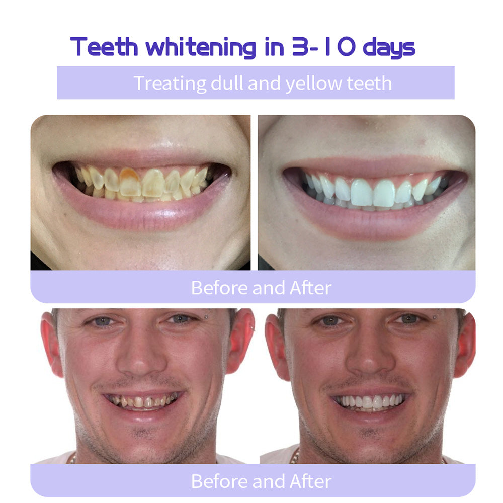 🎁Flash Sale - Don’t Miss Out - ODALIT™ TeethRestoration Mineral Powder🦷(ADA recommended)👩‍⚕️(Treats periodontitis and mouth ulcers, prevents tooth loss, and repairs gum recession)
