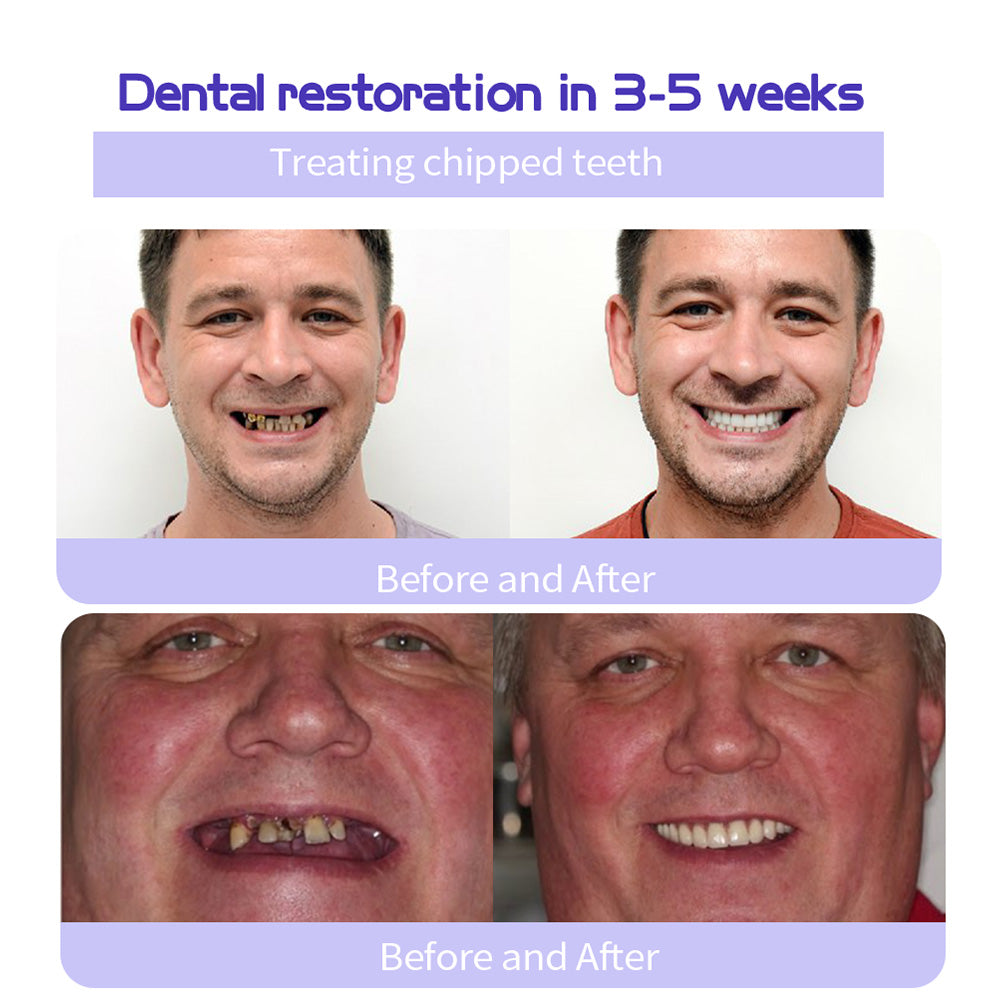 🎁Flash Sale - Don’t Miss Out - ODALIT™ TeethRestoration Mineral Powder🦷(ADA recommended)👩‍⚕️(Treats periodontitis and mouth ulcers, prevents tooth loss, and repairs gum recession)