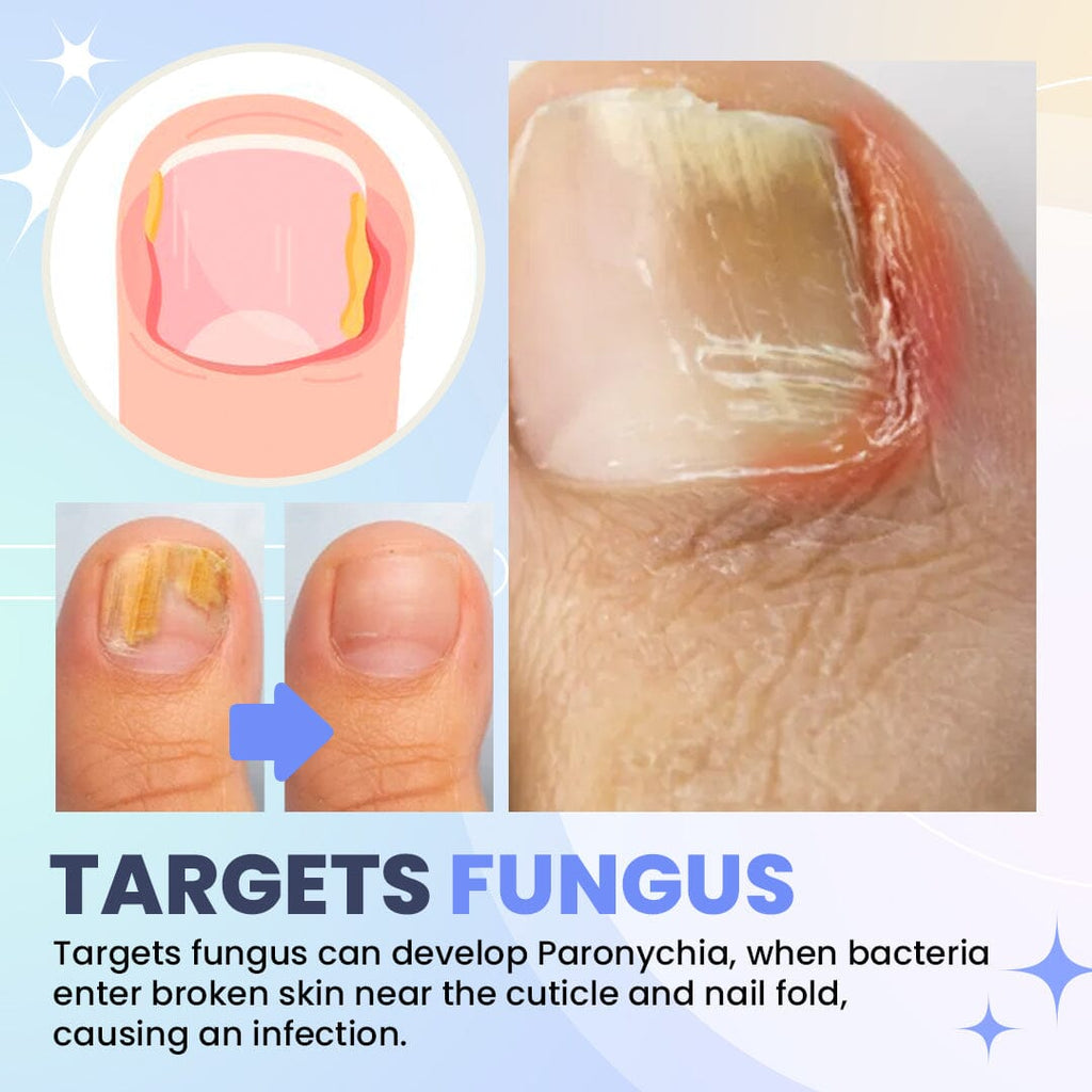 NailPro™ Nail Fungus Light Therapy Device